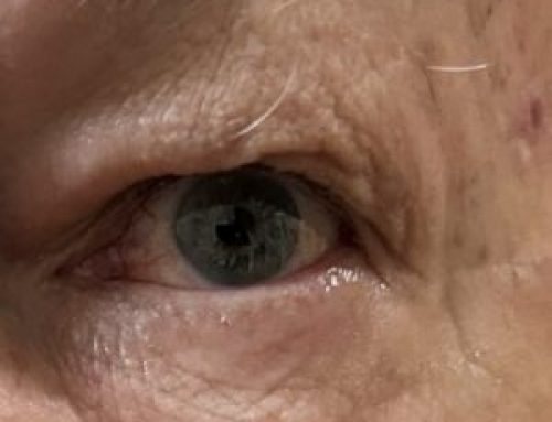 El polen y la irritación de los ojos