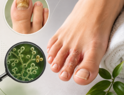 Hongos en los pies y las uñas: cómo prevenir una infección frecuente y difícil de eliminar