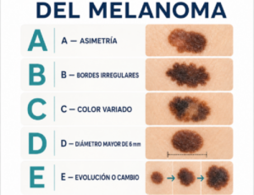 Melanoma: por qué puede ser peligroso y qué debemos hacer para detectarlo a tiempo